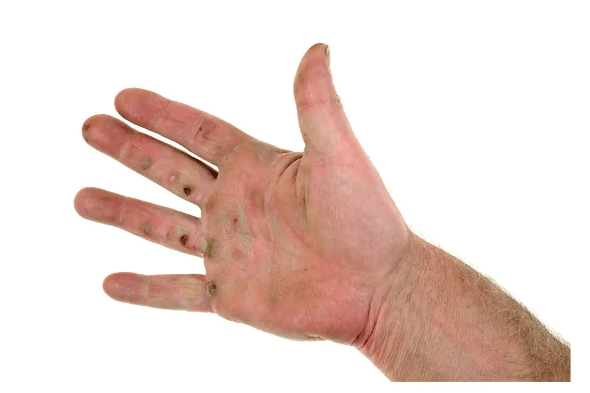 How To Prevent Blisters From Golf (And Why They Happen)
